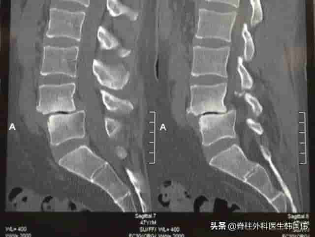 腰L5-骶S1腰椎滑脱，椎间盘突出压迫神经，走路困难该怎么办？