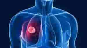 肺节结怎么治疗-肺结节可怕吗？——肺结节的发病原因及治疗