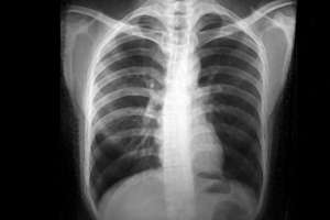 肺部ct-医院做一次CT致癌风险有多大？为什么医生总给患者开CT？真相来了