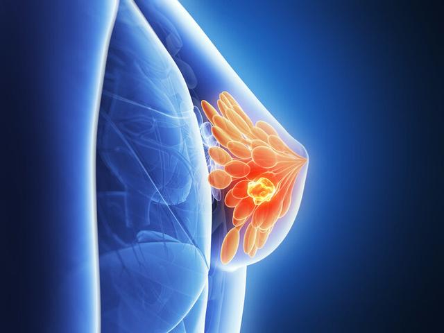 肿瘤科主任直言：好的乳房像蒸好的馒头，自检时留心4种乳腺疾病
