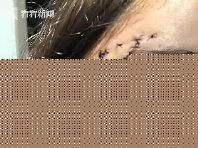 17岁少女拍写真遇惨祸 遭暴怒德国牧羊犬咬脸蛋