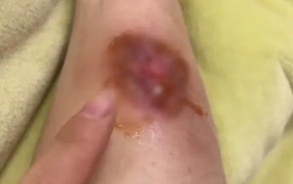 神器变凶器!女子睡醒被撕掉一整块皮,又是因为这件事…