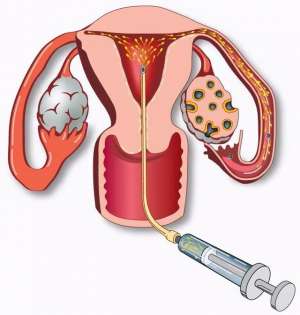美女做人工受精过程(人工授精的过程和条件傻傻的不知道)