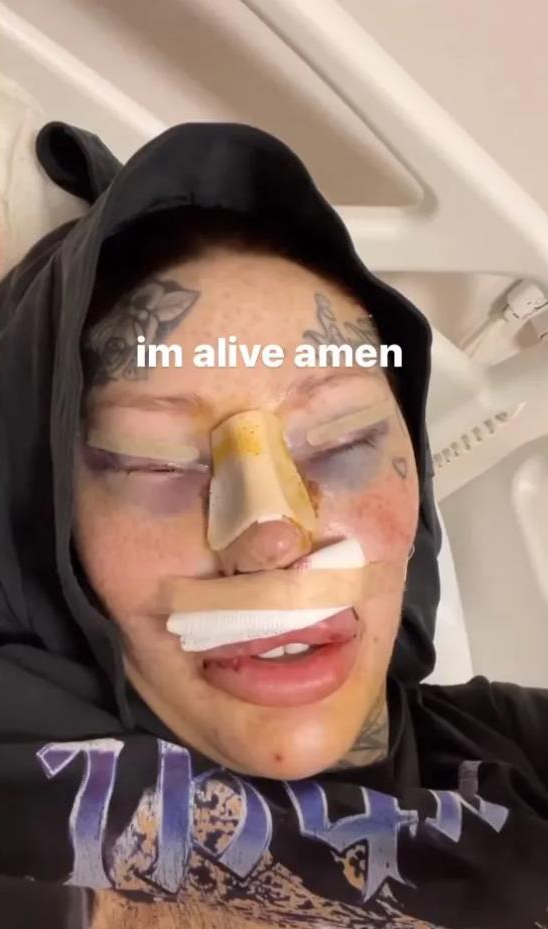 加拿大女网红沉迷整形,结果胸给隆“炸”了,剩单侧巨乳