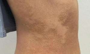 最近的女主播(25岁女主播全身脱皮、奇痒不止，确诊了这个病原因竟是……医生：很少见)