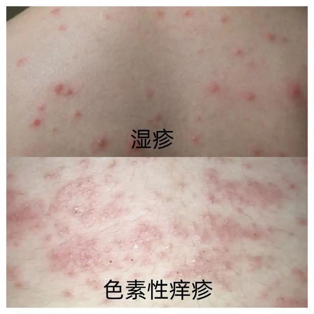 25岁女主播全身脱皮、奇痒不止，确诊了这个病！原因竟是……医生：很少见
