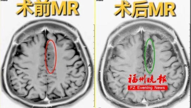 21岁女子睡觉时拳打脚踢,醒来什么都不记得!医生:不是梦游
