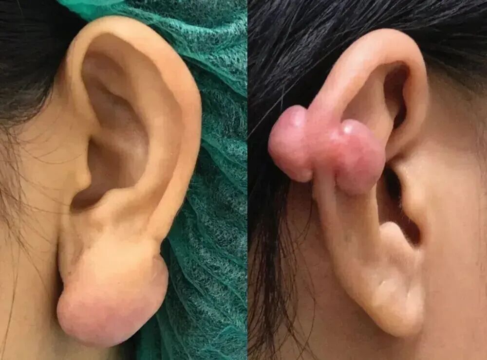 为什么没有人告诉我,打耳洞后会长这种肉疙瘩啊?