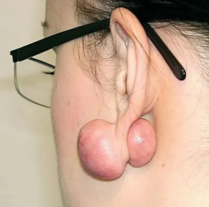 为什么没有人告诉我,打耳洞后会长这种肉疙瘩啊?